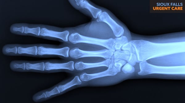 Broken or Sprained: 5 Ways to Tell